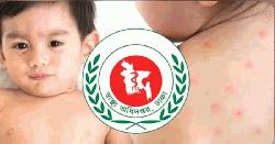 হামের উপসর্গ নিয়ে আরও ৬ শিশুর মৃত্যু
