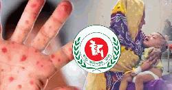 হাম ও হামের উপসর্গ নিয়ে আরও ৬ শিশুর মৃত্যু