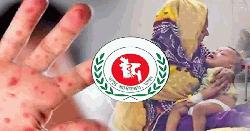 দেশজুড়ে গত ২৪ ঘণ্টায় হাম উপসর্গে ৭ জনের মৃত্যু