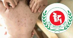 হামের উপসর্গ নিয়ে আরও ৬ শিশুর প্রাণহানি