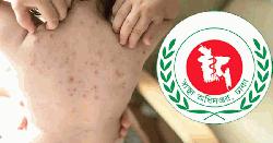 হাম উপসর্গে গত ২৪ ঘণ্টায় ৭ জনের মৃত্যু